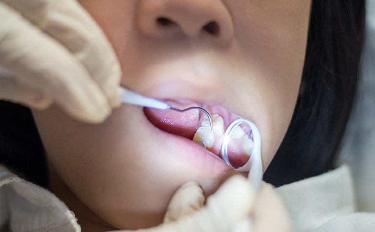 歯の治療風景